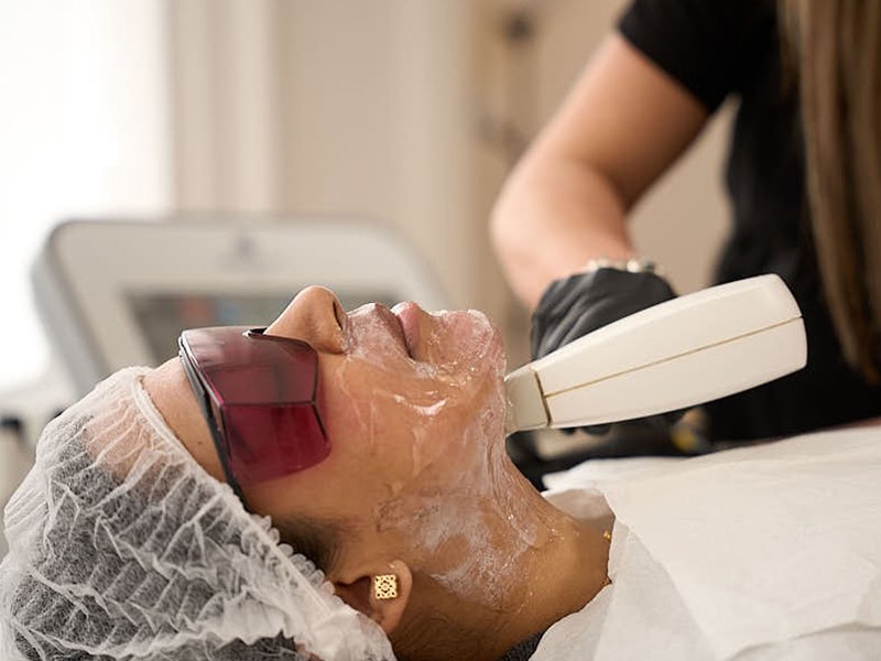 Laser Pigmentation Treatment in London – High-Precision Laser Care for Even and Radiant Skin Tone